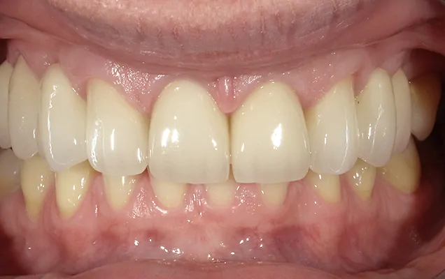 efekty zabiegów stomatologicznych