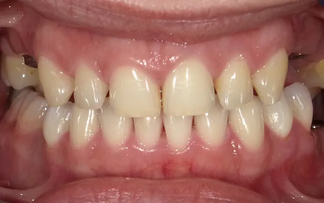 efekty zabiegów stomatologicznych